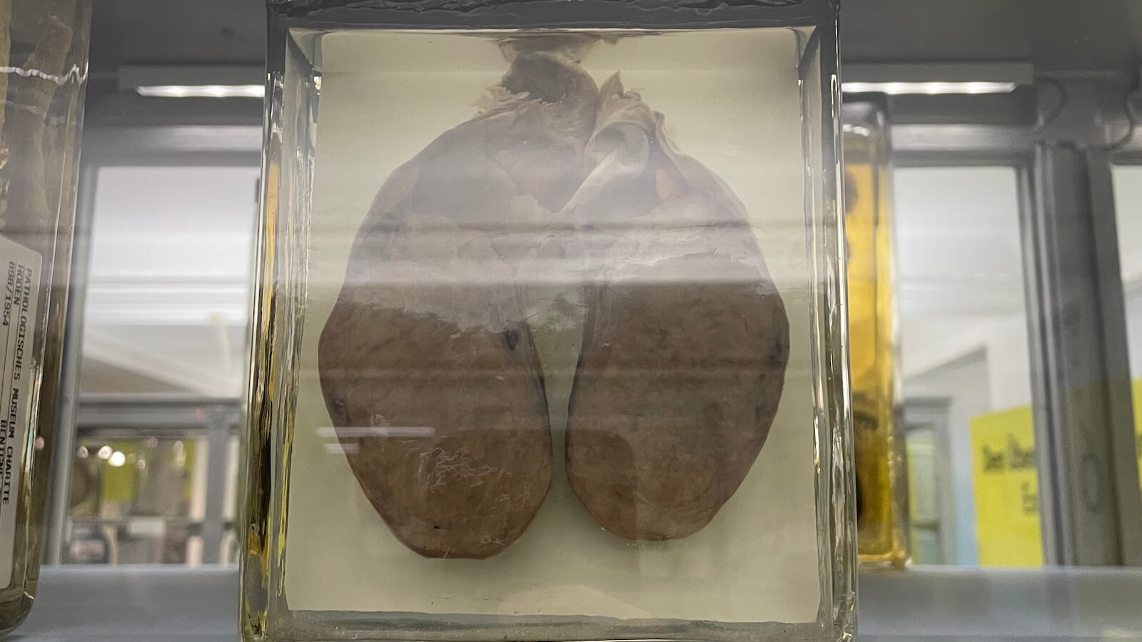 Ein medizinisches Exponat eines Hodenkrebses. Graue organische Masse, knapp faustgroß.